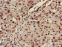 Immunohistochemistry of paraffin-embedded human lung cancer using CAC15184 at dilution of 1:100 Immunohistochemistry of paraffin-embedded human lung cancer using CAC15184 at dilution of 1:100
