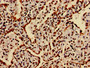 Immunohistochemistry of paraffin-embedded human lung cancer using CAC15186 at dilution of 1:100
