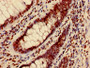 Immunohistochemistry of paraffin-embedded human colon cancer using CAC15188 at dilution of 1:100