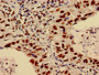 Immunohistochemistry of paraffin-embedded human lung cancer using CAC15188 at dilution of 1:100