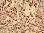 Immunohistochemistry of paraffin-embedded human lung cancer using CAC15189 at dilution of 1:100