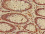 Immunohistochemistry of paraffin-embedded human colon cancer using CAC15191 at dilution of 1:100 Immunohistochemistry of paraffin-embedded human colon cancer using CAC15191 at dilution of 1:100