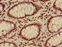 Immunohistochemistry of paraffin-embedded human colon cancer using CAC15193 at dilution of 1:100 Immunohistochemistry of paraffin-embedded human colon cancer using CAC15193 at dilution of 1:100