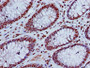 Immunohistochemistry of paraffin-embedded human colon cancer using CAC15201 at dilution of 1:100