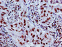 Immunohistochemistry of paraffin-embedded human lung cancer using CAC15201 at dilution of 1:100