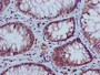 Immunohistochemistry of paraffin-embedded human colon cancer using CAC15203 at dilution of 1:100 Immunohistochemistry of paraffin-embedded human colon cancer using CAC15203 at dilution of 1:100