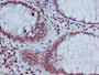 Immunohistochemistry of paraffin-embedded human colon cancer using CAC15204 at dilution of 1:100