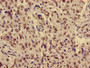 Immunohistochemistry of paraffin-embedded human lung cancer using CAC15211 at dilution of 1:100