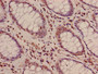 Immunohistochemistry of paraffin-embedded human colon cancer using CAC15216 at dilution of 1:100 Immunohistochemistry of paraffin-embedded human colon cancer using CAC15216 at dilution of 1:100