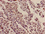 Immunohistochemistry of paraffin-embedded human lung cancer using CAC15216 at dilution of 1:100 Immunohistochemistry of paraffin-embedded human lung cancer using CAC15216 at dilution of 1:100