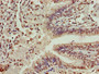 Immunohistochemistry of paraffin-embedded human lung cancer using CAC15225 at dilution of 1:100 Immunohistochemistry of paraffin-embedded human lung cancer using CAC15225 at dilution of 1:100