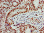 Immunohistochemistry of paraffin-embedded human colon cancer using CAC15227 at dilution of 1:100 Immunohistochemistry of paraffin-embedded human colon cancer using CAC15227 at dilution of 1:100