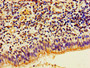 Immunohistochemistry of paraffin-embedded human lung cancer using CAC15241 at dilution of 1:100