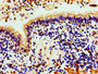 Immunohistochemistry of paraffin-embedded human lung cancer using CAC15244 at dilution of 1:100