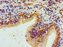 Immunohistochemistry of paraffin-embedded human lung cancer using CAC15246 at dilution of 1:100