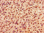 Immunohistochemistry of paraffin-embedded human glioma using CAC15254 at dilution of 1:100