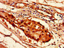 Immunohistochemistry of paraffin-embedded human breast cancer using CAC15254 at dilution of 1:100