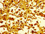 IHC image of CAC15260 diluted at 1:10 and staining in paraffin-embedded human melanoma performed on a Leica BondTM system. After dewaxing and hydration, antigen retrieval was mediated by high pressure in a citrate buffer (pH 6.0). Section was blocked with 10% normal goat serum 30min at RT. Then primary antibody (1% BSA) was incubated at 4°C overnight. The primary is detected by a biotinylated secondary antibody and visualized using an HRP conjugated SP system. IHC image of CAC15260 diluted at 1:10 and staining in paraffin-embedded human melanoma performed on a Leica BondTM system. After dewaxing and hydration, antigen retrieval was mediated by high pressure in a citrate buffer (pH 6.0). Section was blocked with 10% normal goat serum 30min at RT. Then primary antibody (1% BSA) was incubated at 4°C overnight. The primary is detected by a biotinylated secondary antibody and visualized using an HRP conjugated SP system.