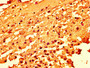 IHC image of CAC15269 diluted at 1:50 and staining in paraffin-embedded human melanoma performed on a Leica BondTM system. After dewaxing and hydration, antigen retrieval was mediated by high pressure in a citrate buffer (pH 6.0). Section was blocked with 10% normal goat serum 30min at RT. Then primary antibody (1% BSA) was incubated at 4°C overnight. The primary is detected by a biotinylated secondary antibody and visualized using an HRP conjugated SP system.