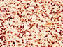 IHC image of CAC15272 diluted at 1:50 and staining in paraffin-embedded human glioma performed on a Leica BondTM system. After dewaxing and hydration, antigen retrieval was mediated by high pressure in a citrate buffer (pH 6.0). Section was blocked with 10% normal goat serum 30min at RT. Then primary antibody (1% BSA) was incubated at 4°C overnight. The primary is detected by a biotinylated secondary antibody and visualized using an HRP conjugated SP system. IHC image of CAC15272 diluted at 1:50 and staining in paraffin-embedded human glioma performed on a Leica BondTM system. After dewaxing and hydration, antigen retrieval was mediated by high pressure in a citrate buffer (pH 6.0). Section was blocked with 10% normal goat serum 30min at RT. Then primary antibody (1% BSA) was incubated at 4°C overnight. The primary is detected by a biotinylated secondary antibody and visualized using an HRP conjugated SP system.
