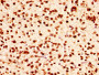 IHC image of CAC15277 diluted at 1:50 and staining in paraffin-embedded human glioma performed on a Leica BondTM system. After dewaxing and hydration, antigen retrieval was mediated by high pressure in a citrate buffer (pH 6.0). Section was blocked with 10% normal goat serum 30min at RT. Then primary antibody (1% BSA) was incubated at 4°C overnight. The primary is detected by a biotinylated secondary antibody and visualized using an HRP conjugated SP system. IHC image of CAC15277 diluted at 1:50 and staining in paraffin-embedded human glioma performed on a Leica BondTM system. After dewaxing and hydration, antigen retrieval was mediated by high pressure in a citrate buffer (pH 6.0). Section was blocked with 10% normal goat serum 30min at RT. Then primary antibody (1% BSA) was incubated at 4°C overnight. The primary is detected by a biotinylated secondary antibody and visualized using an HRP conjugated SP system.