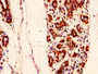 IHC image of CAC15277 diluted at 1:50 and staining in paraffin-embedded human breast cancer performed on a Leica BondTM system. After dewaxing and hydration, antigen retrieval was mediated by high pressure in a citrate buffer (pH 6.0). Section was blocked with 10% normal goat serum 30min at RT. Then primary antibody (1% BSA) was incubated at 4°C overnight. The primary is detected by a biotinylated secondary antibody and visualized using an HRP conjugated SP system. IHC image of CAC15277 diluted at 1:50 and staining in paraffin-embedded human breast cancer performed on a Leica BondTM system. After dewaxing and hydration, antigen retrieval was mediated by high pressure in a citrate buffer (pH 6.0). Section was blocked with 10% normal goat serum 30min at RT. Then primary antibody (1% BSA) was incubated at 4°C overnight. The primary is detected by a biotinylated secondary antibody and visualized using an HRP conjugated SP system.