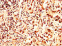 IHC image of CAC15285 diluted at 1:50 and staining in paraffin-embedded human liver cancer performed on a Leica BondTM system. After dewaxing and hydration, antigen retrieval was mediated by high pressure in a citrate buffer (pH 6.0). Section was blocked with 10% normal goat serum 30min at RT. Then primary antibody (1% BSA) was incubated at 4°C overnight. The primary is detected by a biotinylated secondary antibody and visualized using an HRP conjugated SP system.
