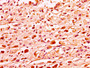 IHC image of CAC15289 diluted at 1:50 and staining in paraffin-embedded human melanoma performed on a Leica BondTM system. After dewaxing and hydration, antigen retrieval was mediated by high pressure in a citrate buffer (pH 6.0). Section was blocked with 10% normal goat serum 30min at RT. Then primary antibody (1% BSA) was incubated at 4°C overnight. The primary is detected by a biotinylated secondary antibody and visualized using an HRP conjugated SP system. IHC image of CAC15289 diluted at 1:50 and staining in paraffin-embedded human melanoma performed on a Leica BondTM system. After dewaxing and hydration, antigen retrieval was mediated by high pressure in a citrate buffer (pH 6.0). Section was blocked with 10% normal goat serum 30min at RT. Then primary antibody (1% BSA) was incubated at 4°C overnight. The primary is detected by a biotinylated secondary antibody and visualized using an HRP conjugated SP system.