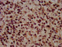 IHC image of CAC15342 diluted at 1:100 and staining in paraffin-embedded human glioma performed on a Leica BondTM system. After dewaxing and hydration, antigen retrieval was mediated by high pressure in a citrate buffer (pH 6.0). Section was blocked with 10% normal goat serum 30min at RT. Then primary antibody (1% BSA) was incubated at 4°C overnight. The primary is detected by a biotinylated secondary antibody and visualized using an HRP conjugated SP system.