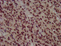 IHC image of CAC15345 diluted at 1:100 and staining in paraffin-embedded human glioma performed on a Leica BondTM system. After dewaxing and hydration, antigen retrieval was mediated by high pressure in a citrate buffer (pH 6.0). Section was blocked with 10% normal goat serum 30min at RT. Then primary antibody (1% BSA) was incubated at 4°C overnight. The primary is detected by a biotinylated secondary antibody and visualized using an HRP conjugated SP system.