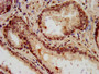 IHC image of CAC15347 diluted at 1:7 and staining in paraffin-embedded human prostate cancer performed on a Leica BondTM system. After dewaxing and hydration, antigen retrieval was mediated by high pressure in a citrate buffer (pH 6.0). Section was blocked with 10% normal goat serum 30min at RT. Then primary antibody (1% BSA) was incubated at 4°C overnight. The primary is detected by a biotinylated secondary antibody and visualized using an HRP conjugated SP system.