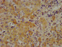 IHC image of CAC15352 diluted at 1:700 and staining in paraffin-embedded human liver cancer performed on a Leica BondTM system. After dewaxing and hydration, antigen retrieval was mediated by high pressure in a citrate buffer (pH 6.0). Section was blocked with 10% normal goat serum 30min at RT. Then primary antibody (1% BSA) was incubated at 4°C overnight. The primary is detected by a biotinylated secondary antibody and visualized using an HRP conjugated SP system.