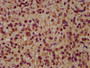 IHC image of CAC15378 diluted at 1:200 and staining in paraffin-embedded human glioma performed on a Leica BondTM system. After dewaxing and hydration, antigen retrieval was mediated by high pressure in a citrate buffer (pH 6.0). Section was blocked with 10% normal goat serum 30min at RT. Then primary antibody (1% BSA) was incubated at 4°C overnight. The primary is detected by a biotinylated secondary antibody and visualized using an HRP conjugated SP system.