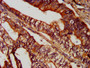 IHC image of CAC15384 diluted at 1:300 and staining in paraffin-embedded human colon cancer performed on a Leica BondTM system. After dewaxing and hydration, antigen retrieval was mediated by high pressure in a citrate buffer (pH 6.0). Section was blocked with 10% normal goat serum 30min at RT. Then primary antibody (1% BSA) was incubated at 4°C overnight. The primary is detected by a biotinylated secondary antibody and visualized using an HRP conjugated SP system.