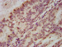 IHC image of CAC15393 diluted at 1:100 and staining in paraffin-embedded human endometrial cancer performed on a Leica BondTM system. After dewaxing and hydration, antigen retrieval was mediated by high pressure in a citrate buffer (pH 6.0). Section was blocked with 10% normal goat serum 30min at RT. Then primary antibody (1% BSA) was incubated at 4°C overnight. The primary is detected by a biotinylated secondary antibody and visualized using an HRP conjugated SP system.