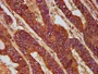 IHC image of CAC15422 diluted at 1:200 and staining in paraffin-embedded human colon cancer performed on a Leica BondTM system. After dewaxing and hydration, antigen retrieval was mediated by high pressure in a citrate buffer (pH 6.0). Section was blocked with 10% normal goat serum 30min at RT. Then primary antibody (1% BSA) was incubated at 4°C overnight. The primary is detected by a biotinylated secondary antibody and visualized using an HRP conjugated SP system.