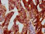 IHC image of CAC15423 diluted at 1:500 and staining in paraffin-embedded human colon cancer performed on a Leica BondTM system. After dewaxing and hydration, antigen retrieval was mediated by high pressure in a citrate buffer (pH 6.0). Section was blocked with 10% normal goat serum 30min at RT. Then primary antibody (1% BSA) was incubated at 4°C overnight. The primary is detected by a biotinylated secondary antibody and visualized using an HRP conjugated SP system.