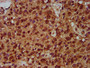 IHC image of CAC15431 diluted at 1:200 and staining in paraffin-embedded human glioma performed on a Leica BondTM system. After dewaxing and hydration, antigen retrieval was mediated by high pressure in a citrate buffer (pH 6.0). Section was blocked with 10% normal goat serum 30min at RT. Then primary antibody (1% BSA) was incubated at 4°C overnight. The primary is detected by a biotinylated secondary antibody and visualized using an HRP conjugated SP system.