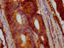 IHC image of CAC15436 diluted at 1:400 and staining in paraffin-embedded human colon cancer performed on a Leica BondTM system. After dewaxing and hydration, antigen retrieval was mediated by high pressure in a citrate buffer (pH 6.0). Section was blocked with 10% normal goat serum 30min at RT. Then primary antibody (1% BSA) was incubated at 4°C overnight. The primary is detected by a biotinylated secondary antibody and visualized using an HRP conjugated SP system.