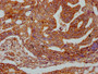IHC image of CAC15439 diluted at 1:400 and staining in paraffin-embedded human colon cancer performed on a Leica BondTM system. After dewaxing and hydration, antigen retrieval was mediated by high pressure in a citrate buffer (pH 6.0). Section was blocked with 10% normal goat serum 30min at RT. Then primary antibody (1% BSA) was incubated at 4°C overnight. The primary is detected by a biotinylated secondary antibody and visualized using an HRP conjugated SP system.