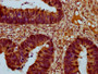 IHC image of CAC15440 diluted at 1:400 and staining in paraffin-embedded human ovarian cancer performed on a Leica BondTM system. After dewaxing and hydration, antigen retrieval was mediated by high pressure in a citrate buffer (pH 6.0). Section was blocked with 10% normal goat serum 30min at RT. Then primary antibody (1% BSA) was incubated at 4°C overnight. The primary is detected by a biotinylated secondary antibody and visualized using an HRP conjugated SP system.