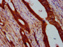 IHC image of CAC15441 diluted at 1:400 and staining in paraffin-embedded human colon cancer performed on a Leica BondTM system. After dewaxing and hydration, antigen retrieval was mediated by high pressure in a citrate buffer (pH 6.0). Section was blocked with 10% normal goat serum 30min at RT. Then primary antibody (1% BSA) was incubated at 4°C overnight. The primary is detected by a biotinylated secondary antibody and visualized using an HRP conjugated SP system.