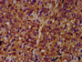 IHC image of CAC15441 diluted at 1:400 and staining in paraffin-embedded human glioma performed on a Leica BondTM system. After dewaxing and hydration, antigen retrieval was mediated by high pressure in a citrate buffer (pH 6.0). Section was blocked with 10% normal goat serum 30min at RT. Then primary antibody (1% BSA) was incubated at 4°C overnight. The primary is detected by a biotinylated secondary antibody and visualized using an HRP conjugated SP system.