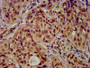 IHC image of CAC15454 diluted at 1:30 and staining in paraffin-embedded human cervical cancer performed on a Leica BondTM system. After dewaxing and hydration, antigen retrieval was mediated by high pressure in a citrate buffer (pH 6.0). Section was blocked with 10% normal goat serum 30min at RT. Then primary antibody (1% BSA) was incubated at 4°C overnight. The primary is detected by a biotinylated secondary antibody and visualized using an HRP conjugated SP system.