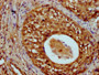 IHC image of CAC15458 diluted at 1:20 and staining in paraffin-embedded human cervical cancer performed on a Leica BondTM system. After dewaxing and hydration, antigen retrieval was mediated by high pressure in a citrate buffer (pH 6.0). Section was blocked with 10% normal goat serum 30min at RT. Then primary antibody (1% BSA) was incubated at 4°C overnight. The primary is detected by a biotinylated secondary antibody and visualized using an HRP conjugated SP system.