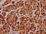 IHC image of CAC15464 diluted at 1:20 and staining in paraffin-embedded human pancreatic cancer performed on a Leica BondTM system. After dewaxing and hydration, antigen retrieval was mediated by high pressure in a citrate buffer (pH 6.0). Section was blocked with 10% normal goat serum 30min at RT. Then primary antibody (1% BSA) was incubated at 4°C overnight. The primary is detected by a biotinylated secondary antibody and visualized using an HRP conjugated SP system. IHC image of CAC15464 diluted at 1:20 and staining in paraffin-embedded human pancreatic cancer performed on a Leica BondTM system. After dewaxing and hydration, antigen retrieval was mediated by high pressure in a citrate buffer (pH 6.0). Section was blocked with 10% normal goat serum 30min at RT. Then primary antibody (1% BSA) was incubated at 4°C overnight. The primary is detected by a biotinylated secondary antibody and visualized using an HRP conjugated SP system.