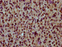 IHC image of CAC15467 diluted at 1:30 and staining in paraffin-embedded human glioma performed on a Leica BondTM system. After dewaxing and hydration, antigen retrieval was mediated by high pressure in a citrate buffer (pH 6.0). Section was blocked with 10% normal goat serum 30min at RT. Then primary antibody (1% BSA) was incubated at 4°C overnight. The primary is detected by a biotinylated secondary antibody and visualized using an HRP conjugated SP system. IHC image of CAC15467 diluted at 1:30 and staining in paraffin-embedded human glioma performed on a Leica BondTM system. After dewaxing and hydration, antigen retrieval was mediated by high pressure in a citrate buffer (pH 6.0). Section was blocked with 10% normal goat serum 30min at RT. Then primary antibody (1% BSA) was incubated at 4°C overnight. The primary is detected by a biotinylated secondary antibody and visualized using an HRP conjugated SP system.