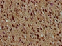 IHC image of CAC15470 diluted at 1:5 and staining in paraffin-embedded human glioma performed on a Leica BondTM system. After dewaxing and hydration, antigen retrieval was mediated by high pressure in a citrate buffer (pH 6.0). Section was blocked with 10% normal goat serum 30min at RT. Then primary antibody (1% BSA) was incubated at 4°C overnight. The primary is detected by a biotinylated secondary antibody and visualized using an HRP conjugated SP system.