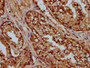 IHC image of CAC15477 diluted at 1:25 and staining in paraffin-embedded human prostate cancer performed on a Leica BondTM system. After dewaxing and hydration, antigen retrieval was mediated by high pressure in a citrate buffer (pH 6.0). Section was blocked with 10% normal goat serum 30min at RT. Then primary antibody (1% BSA) was incubated at 4°C overnight. The primary is detected by a biotinylated secondary antibody and visualized using an HRP conjugated SP system.