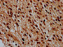 IHC image of CAC15481 diluted at 1:100 and staining in paraffin-embedded human glioma performed on a Leica BondTM system. After dewaxing and hydration, antigen retrieval was mediated by high pressure in a citrate buffer (pH 6.0). Section was blocked with 10% normal goat serum 30min at RT. Then primary antibody (1% BSA) was incubated at 4°C overnight. The primary is detected by a biotinylated secondary antibody and visualized using an HRP conjugated SP system. IHC image of CAC15481 diluted at 1:100 and staining in paraffin-embedded human glioma performed on a Leica BondTM system. After dewaxing and hydration, antigen retrieval was mediated by high pressure in a citrate buffer (pH 6.0). Section was blocked with 10% normal goat serum 30min at RT. Then primary antibody (1% BSA) was incubated at 4°C overnight. The primary is detected by a biotinylated secondary antibody and visualized using an HRP conjugated SP system.